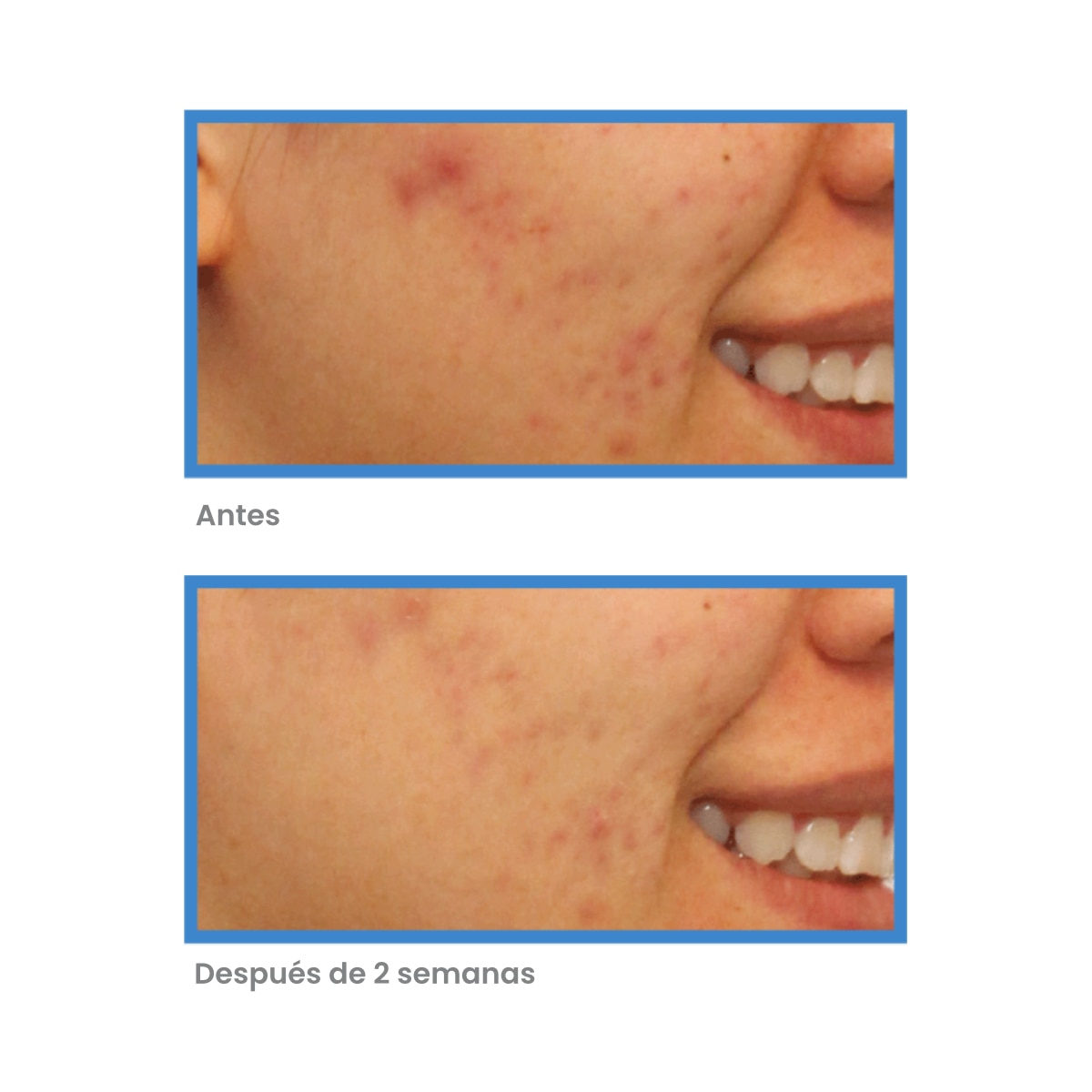 BLEMISH CONTROL CLARIFYING CLEANSER 200ML (LIMPIADOR FACIAL)